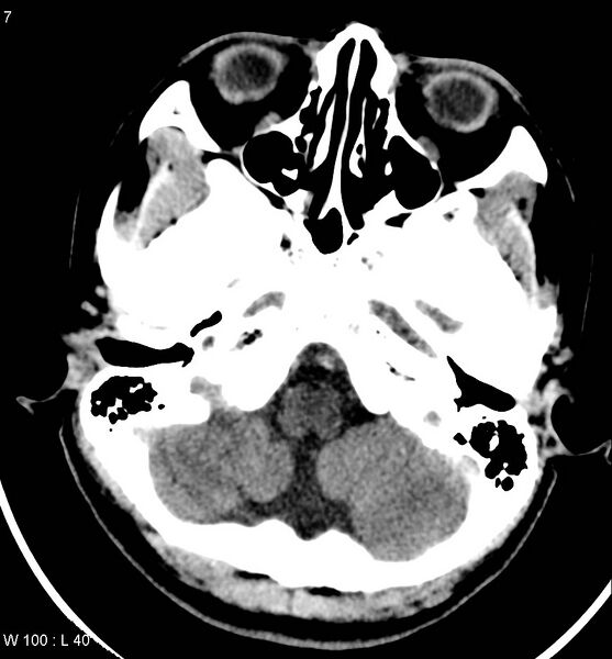 File:Aicardi syndrome (Radiopaedia 5353-7116 Axial non-contrast 4).jpg