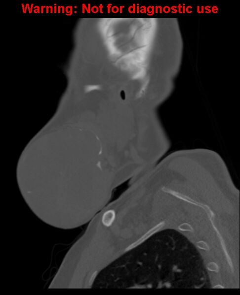 File:Ameloblastoma (Radiopaedia 33126-34164 Sagittal bone window 17).jpg