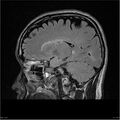 Amnestic syndrome secondary to hypoxic brain injury (Radiopaedia 24743-25004 D 3).jpg
