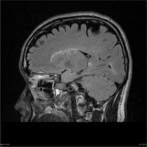 File:Amnestic syndrome secondary to hypoxic brain injury (Radiopaedia 24743-25004 D 3).jpg