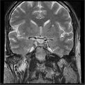 Amnestic syndrome secondary to hypoxic brain injury (Radiopaedia 24743-25004 F 13).jpg