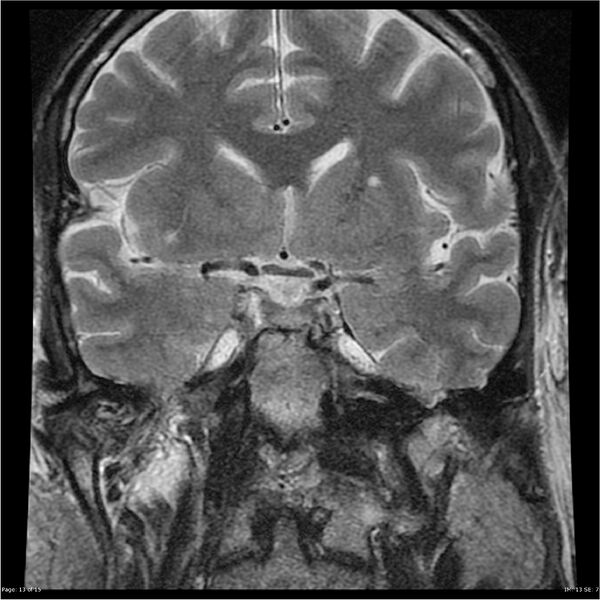 File:Amnestic syndrome secondary to hypoxic brain injury (Radiopaedia 24743-25004 F 13).jpg