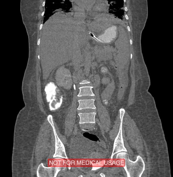 File:Amoebic enterocolitis with liver abscess (Radiopaedia 35100-36609 B 113).jpg