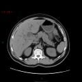 Ampullary carcinoma (Radiopaedia 56396-63056 Axial non-contrast 16).jpg