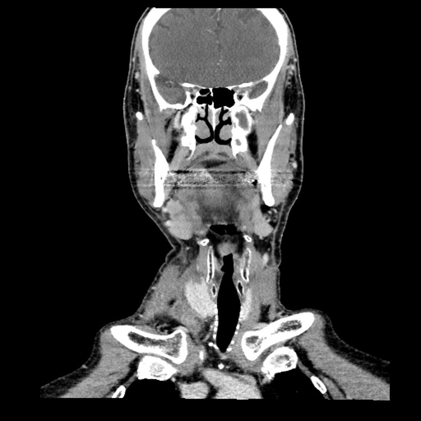 Anaplastic thyroid carcinoma (Radiopaedia 79087-92034 A 50).jpg