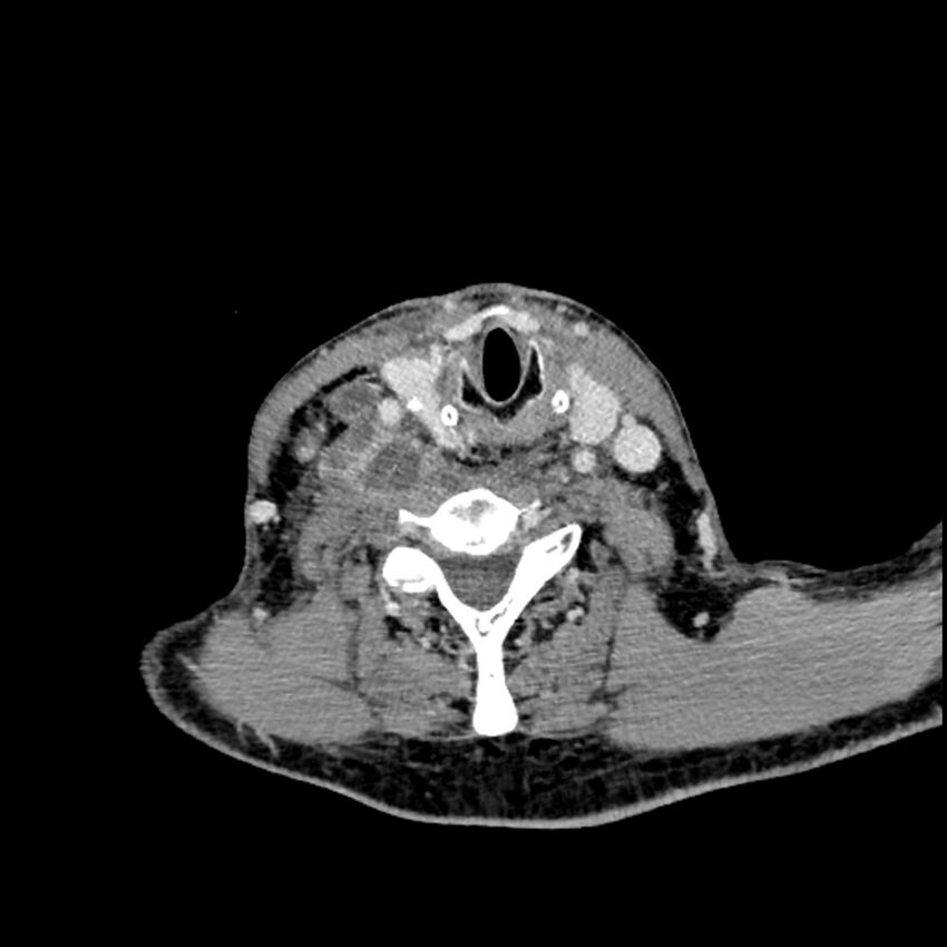 Anaplastic thyroid carcinoma (Radiopaedia 79087-92034 B 52).jpg