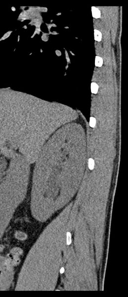 File:Aneurysmal bone cyst T11 (Radiopaedia 29294-29721 E 74).jpg
