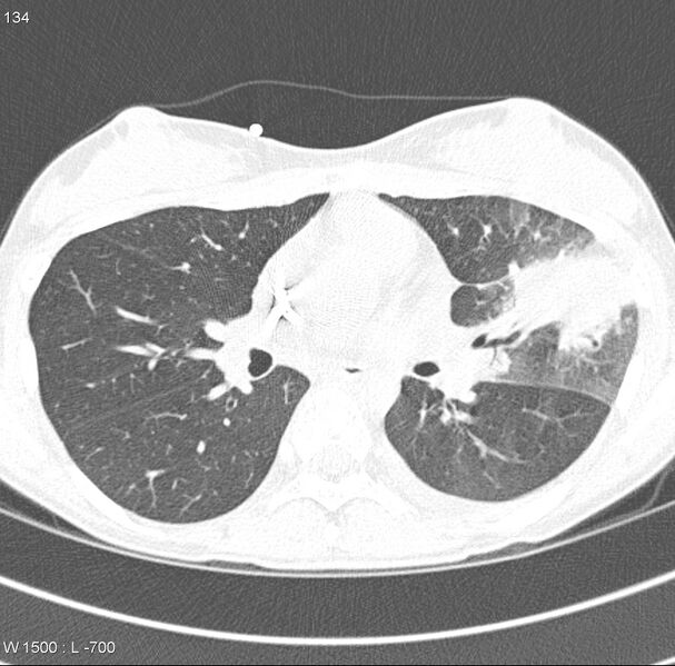 File:Angioinvasive aspergillosis (Radiopaedia 8651-9466 Axial lung window 6).jpg