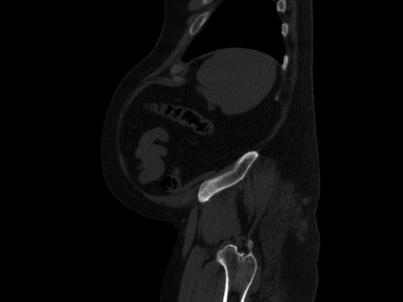 File:Ankylosing spondylitis (Radiopaedia 44609-48357 Sagittal bone window 99).jpg