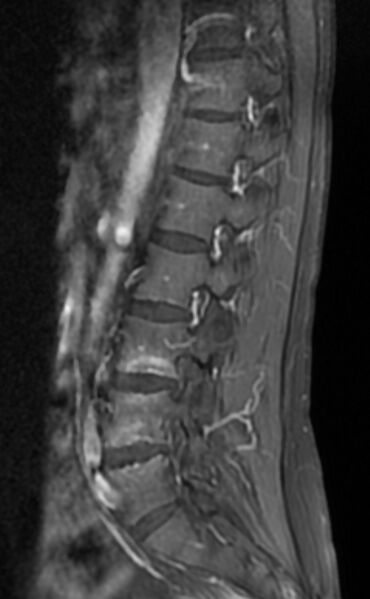 File:Ankylosing spondylitis - Andersson lesion (Radiopaedia 81878-95838 F 9).jpg