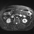 Annular pancreas (Radiopaedia 38292-40320 Axial T2 fat sat 24).png