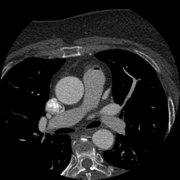 File:Anomalous origin of left circumflex artery from right coronary sinus (Radiopaedia 72563-83117 B 15).jpg