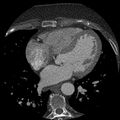 Anomalous origin of left circumflex artery from right coronary sinus (Radiopaedia 72563-83117 B 86).jpg