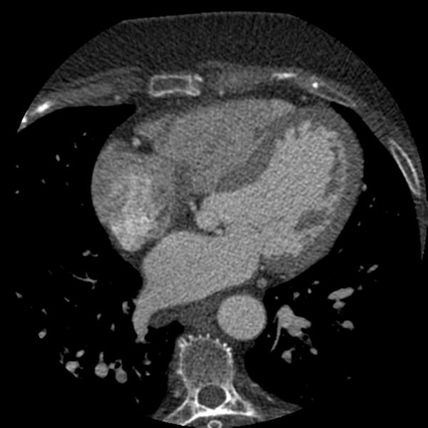 File:Anomalous origin of left circumflex artery from right coronary sinus (Radiopaedia 72563-83117 B 86).jpg