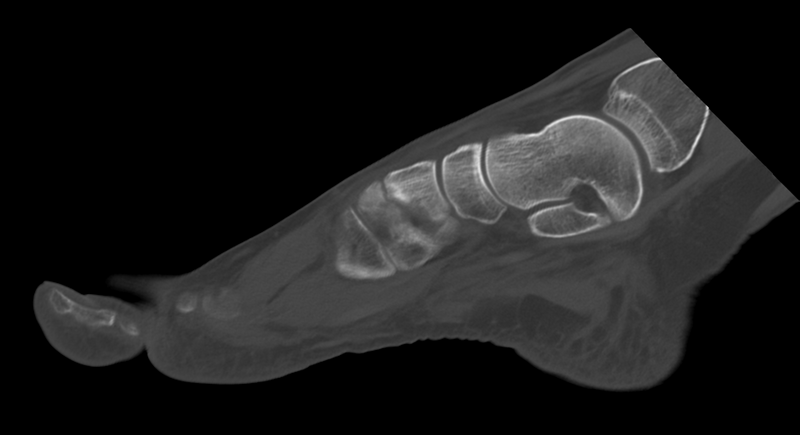 File:Anterior calcaneal process fracture (Radiopaedia 47384-51989 Sagittal bone window 20).png