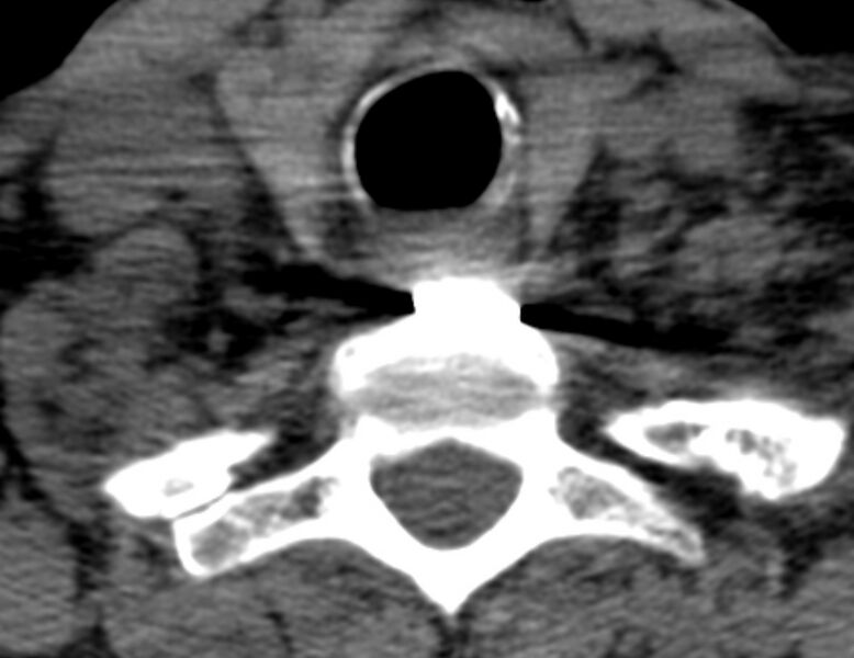 File:Anterior cervical postdiscectomy arthrodesis (Radiopaedia 32678-33646 Axial non-contrast 64).jpg