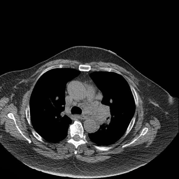 File:Aortic arch false aneurysm (Radiopaedia 14667-14587 Axial non-contrast 17).jpg