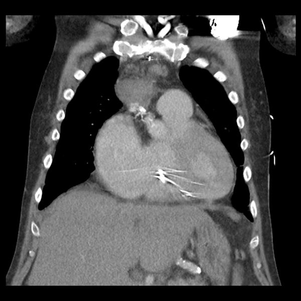 File:Aortic arch graft infection (FDG PET-CT) (Radiopaedia 71975-82437 Coronal 21).jpg