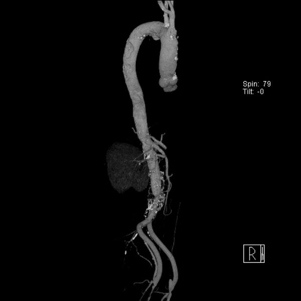 File:Aortic arch saccular aneurysm (Radiopaedia 19430-19457 A 15).jpg