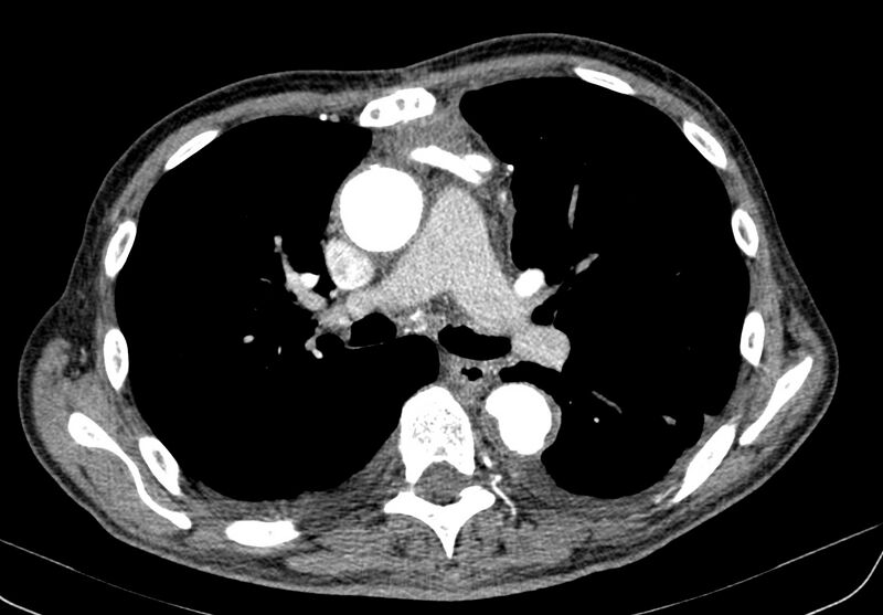 File:Aortic arch saccular aneurysm (Radiopaedia 19430-19457 B 16).jpg