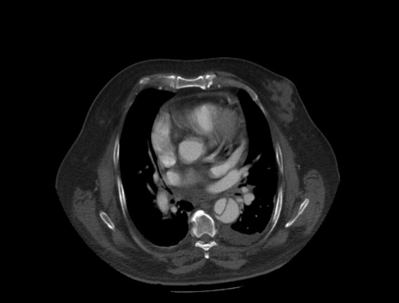 File:Aortic dissection (Radiopaedia 28802-29105 A 20).jpg