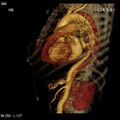 Aortic dissection with rupture into pericardium (Radiopaedia 12384-12647 C+ arterial phase 30).jpg
