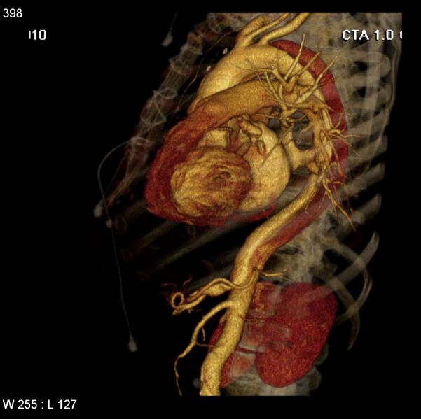 File:Aortic dissection with rupture into pericardium (Radiopaedia 12384-12647 C+ arterial phase 30).jpg
