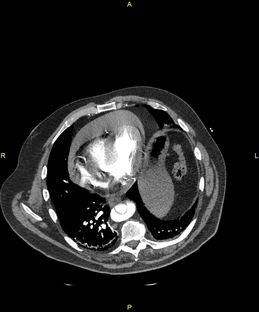 Aortic rupture (Radiopaedia 88822-105594 B 170).jpg