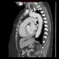 Aortic valve stenosis (Radiopaedia 14480-14423 B 8).jpg