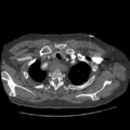 Aorto-coronary bypass graft aneurysms (Radiopaedia 40562-43157 A 19).png