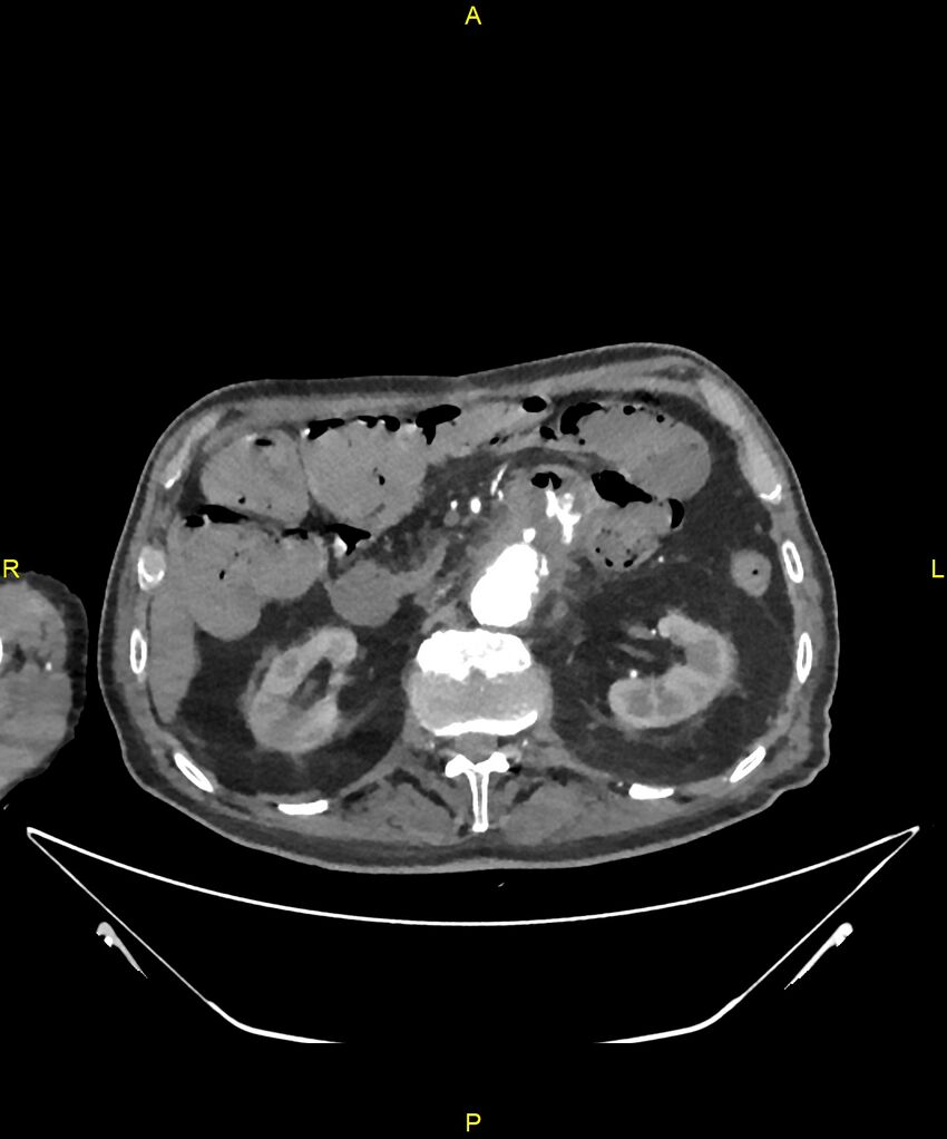 Aortoenteric fistula (Radiopaedia 84308-99603 B 123).jpg