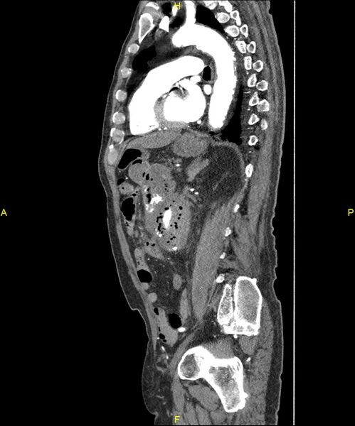 File:Aortoenteric fistula (Radiopaedia 84308-99603 C 213).jpg