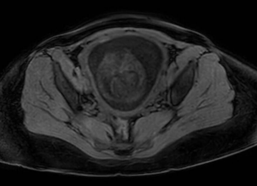 Appendicitis in gravida (MRI) (Radiopaedia 89433-106395 Axial DIXON 125).jpg