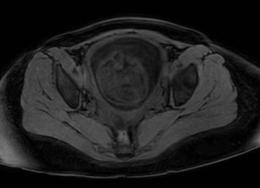 Appendicitis in gravida (MRI) (Radiopaedia 89433-106395 Axial DIXON 128).jpg