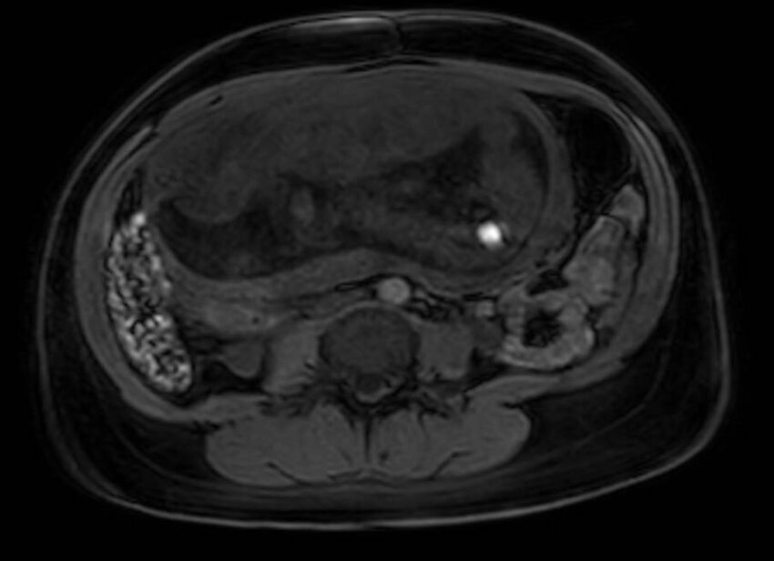 Appendicitis in gravida (MRI) (Radiopaedia 89433-106395 Axial DIXON 75).jpg