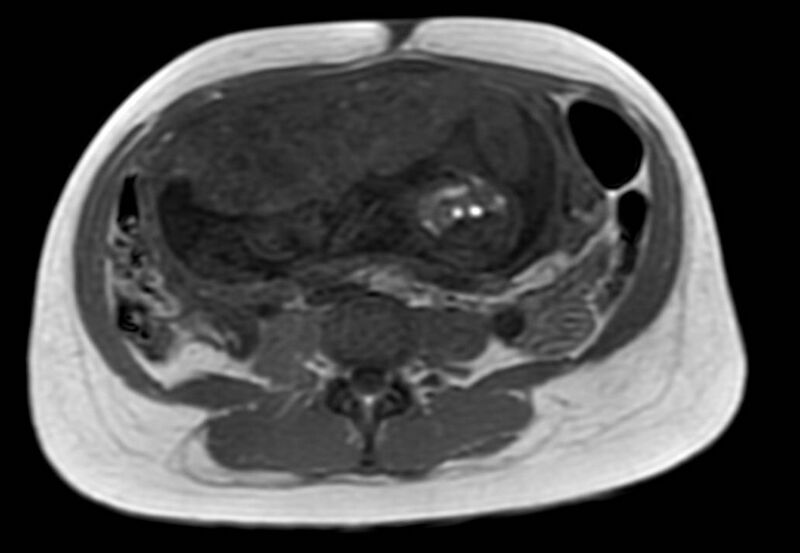 File:Appendicitis in gravida (MRI) (Radiopaedia 89433-106395 Axial T1 in-phase 38).jpg