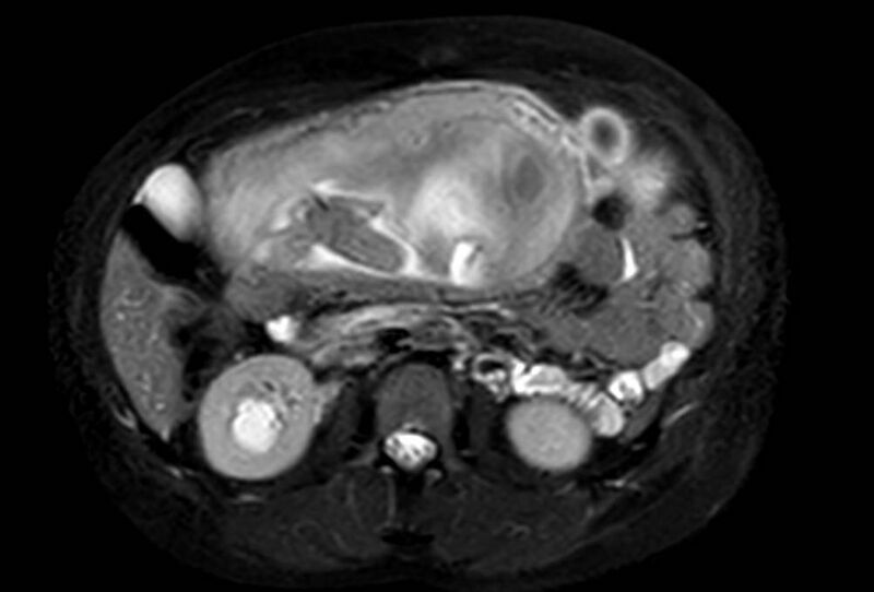 File:Appendicitis in gravida (MRI) (Radiopaedia 89433-106395 Axial T2 SPAIR 33).jpg