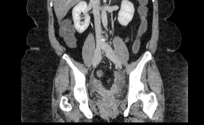 Appendix mucocele (Radiopaedia 41222-44033 B 53).jpg
