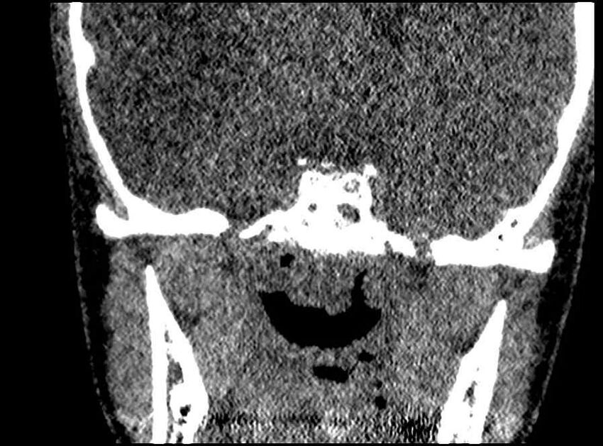 Arachnoid cyst- extremely large (Radiopaedia 68741-78450 Coronal bone window 8).jpg