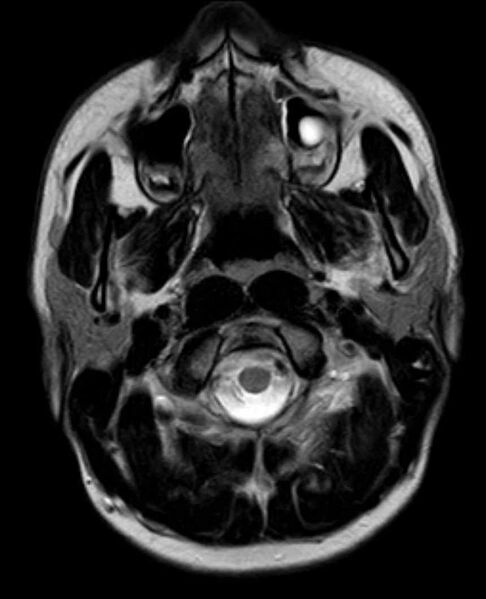 File:Arachnoid cyst- extremely large (Radiopaedia 68741-78451 Axial T2 2).jpg