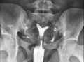 Arcuate uterus (Radiopaedia 87335-103630 D 1).jpg