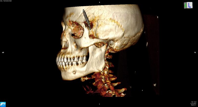 File:Arrow injury to the head (Radiopaedia 75266-86388 3D horizontal 15).jpg