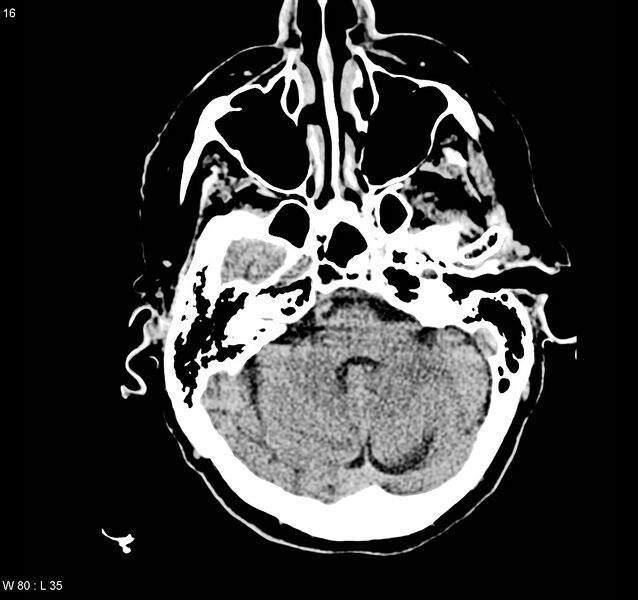 File:Arteriovenous malformation - cerebral (Radiopaedia 8172-9020 Axial non-contrast 4).jpg
