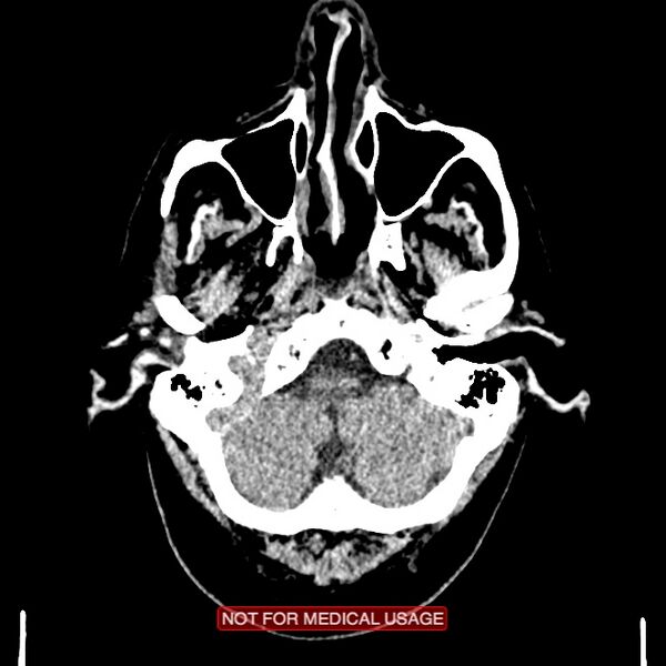 File:Artery of Percheron infarction (Radiopaedia 28679-28967 Axial non-contrast 17).jpg
