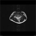 Arthrogryposis and muscle atrophy (Radiopaedia 24081-24314 T1 15).jpg