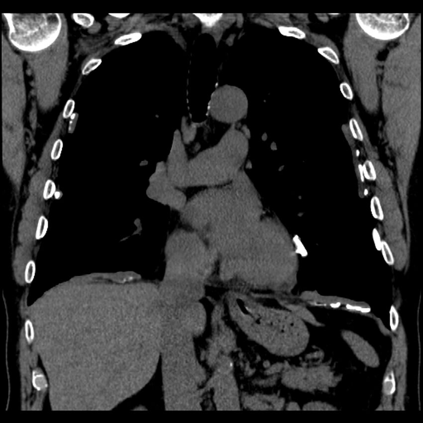 Asbestos-related pleural plaques (Radiopaedia 39069-41255 Coronal non-contrast 47).jpg