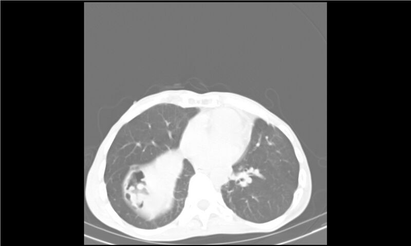 File:Aspergilloma (Radiopaedia 20788-20701 Axial lung window 23).jpg