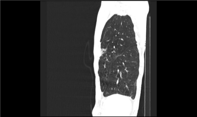File:Aspergilloma (Radiopaedia 20788-20701 Sagittal lung window 2).jpg