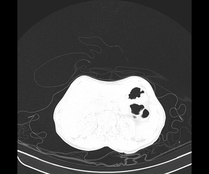 File:Aspergillomas (Radiopaedia 66779-76110 Axial lung window 51).jpg