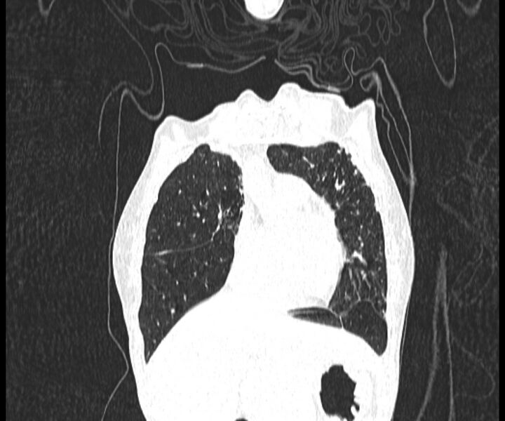 File:Aspergillomas (Radiopaedia 66779-76110 Coronal lung window 5).jpg